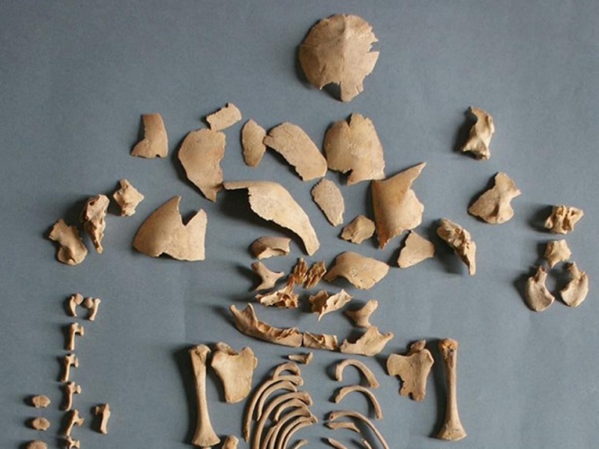 Remains of individual “CRU001”, who the researchers discovered had Down syndrome