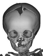 Images created from a CT scan of a baby with cleft lip and palate, showing the skeleton
Images courtesy of Dr David Netherway