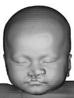 Images created from a CT scan of a baby with cleft lip and palate, showing the skin surface
Images courtesy of Dr David Netherway