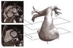 A 3D reconstruction of the right atrium from scans of cardiac chambers.  The selected magnetic resonance (MR) images that correspond to the sectioning of left and  right atria are used for examination and flow analyses.
Image courtesy of Kelvin Wong