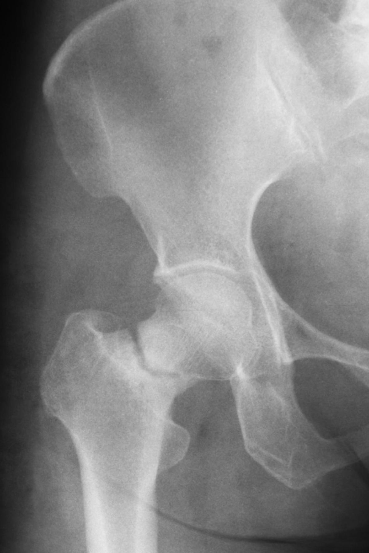 A stock photo of a hip x-ray showing a femoral neck fracture.