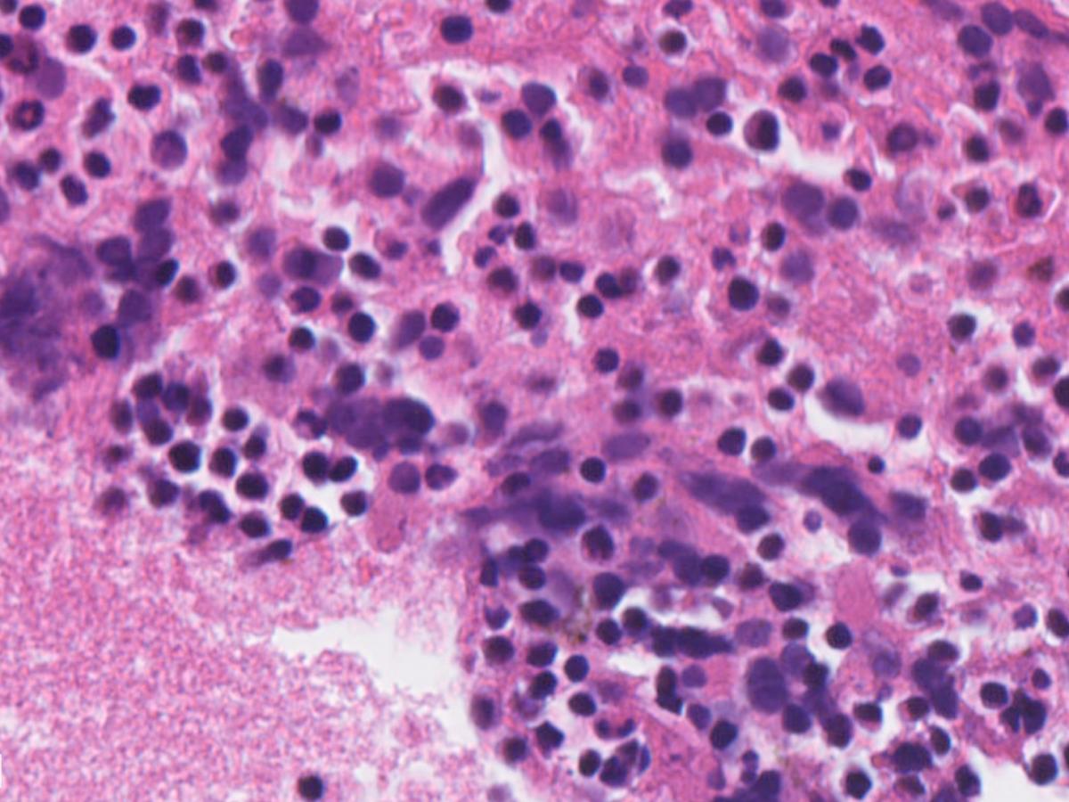 SAiGENCI - lung tumour