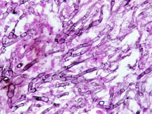 Aspergillosis of the lung. Methenamine silver stained tissue section showing dichotomously branched, septate hyphae.