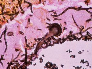 Aspergillosis of the lung. Methenamine silver stained tissue section showing a conidial head of A. fumigatus (right).