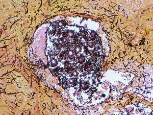 Lung tissue showing fungus balls of hyphae of A. fumigatus. Note: conidial heads forming in an alveolus.