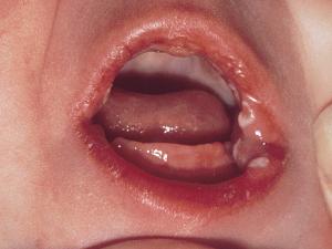 Oral candidiasis in a new born.