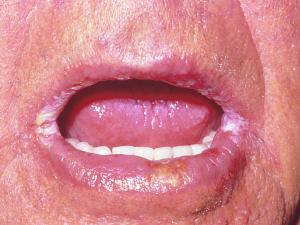 Angular cheilitis caused by Candida albicans