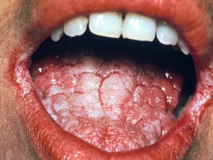 Oral candidiasis in an immunosuppressed patient.