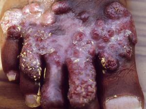 Chronic verrucous chromoblastomycosis of the hand.