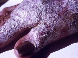 Chronic verrucous chromoblastomycosis of the hand due C.  carrionii.