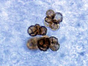 Chromoblastomycosis sclerotic bodies