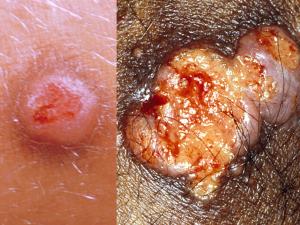 Nodular and ulcerated skin lesion caused by C. neoformans.