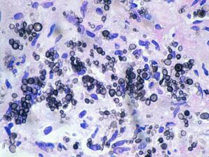 Tissue section of lung showing showing atypical non-encapsulated yeast cells of C. neoformans.