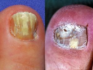 Tinea of the toe nails caused by T. rubrum.