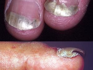 Tinea of the finger nails caused by T. rubrum (top) and T. tonsurans (bottom).