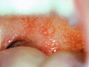 Typical papules often with a central necrotic umbilication on the buccal cavity due to T. marneffei.