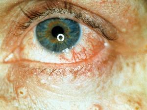 Lesions found on the eye.