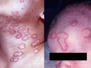 Tinea corporis caused by M. canis following contact with infectious kittens.