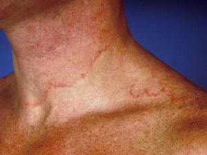 Tinea corporis caused by T. rubrum.