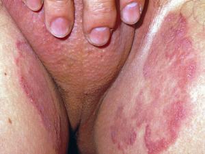 Tinea of the groin showing typical erythematous lesions on the inner thighs.