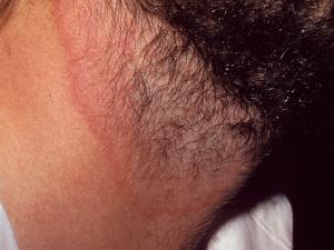 Tinea of the groin showing typical erythematous lesions on the inner thighs.