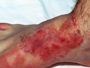 Tinea incognito or steroid modified tinea pedis caused by T. rubrum.