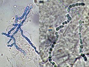 KOH mount of infected skin scales (left) and nail material (right) showing typical dermatophyte hyphae breaking up into arthroconidia