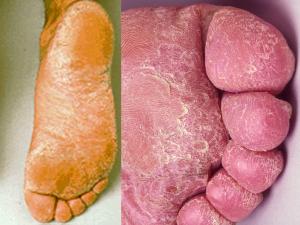 Moccasin-type tinea pedis caused by E. floccosum.