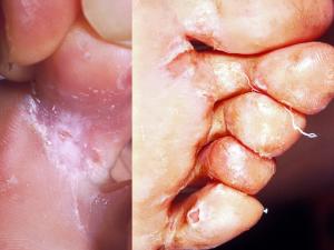 Sub-clinical infection (left) showing mild maceration under the little toe and more severe infection showing extensive maceration of all toe web spaces.
