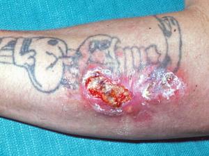 Ulcerated cutaneous zygomycosis.