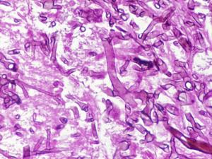 Tissue morphology in zygomycosis showing distinctive infrequently septate thin walled hyphae with focal bulbous dilations and irregular branching, typical for those species belonging to the Mucorales.