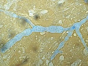 Tissue morphology in zygomycosis showing distinctive infrequently septate thin walled hyphae with focal bulbous dilations and irregular branching, typical for those species belonging to the Mucorales.