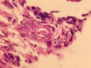 Sporothrix schenckii PAS stained tissue section showing budding yeast-like cells.