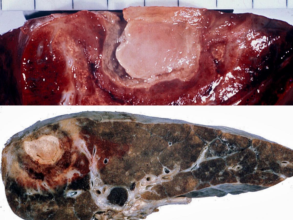 Aspergilloma formed by the colonisation of a pre-formed lung cavity.
