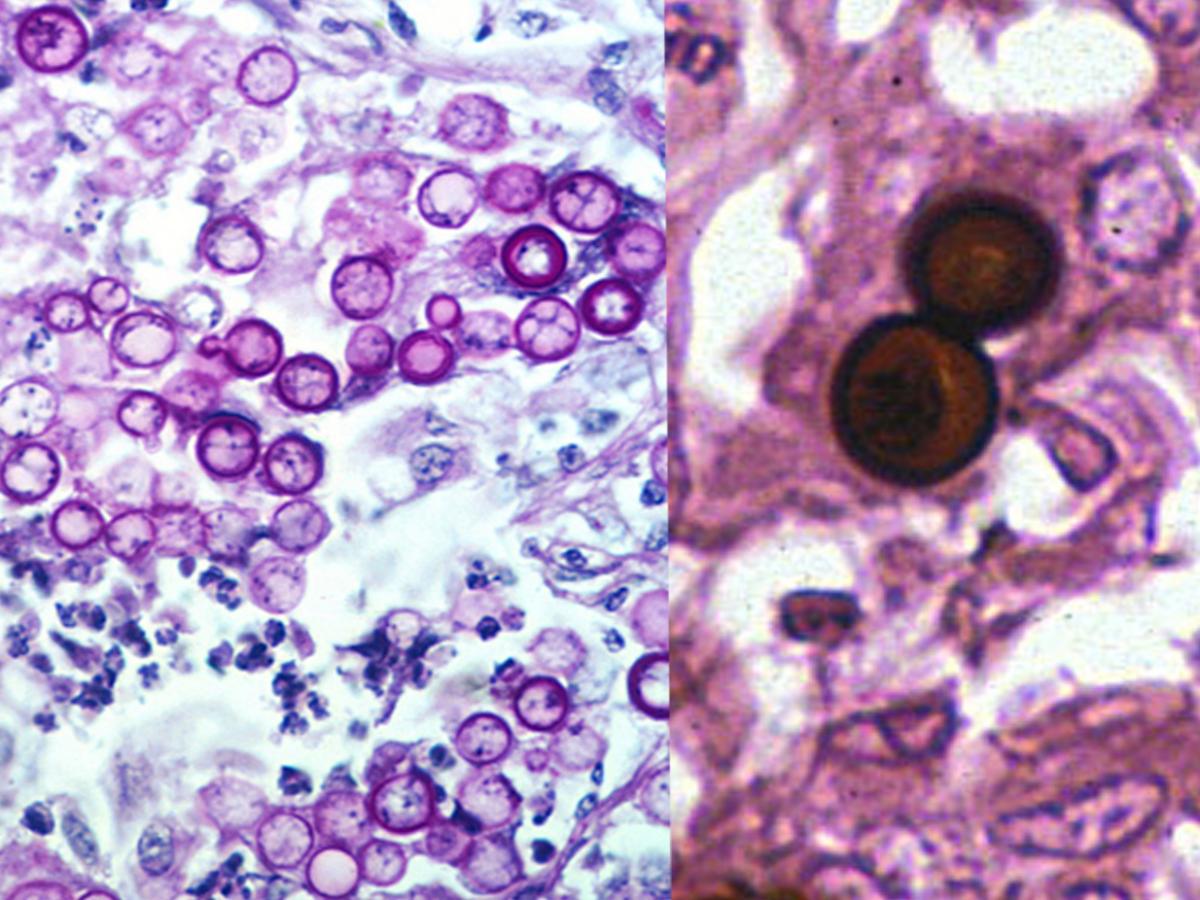 Blastomyces histology
