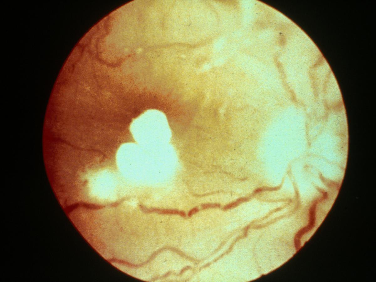 Endophthalmitis due to Candida.