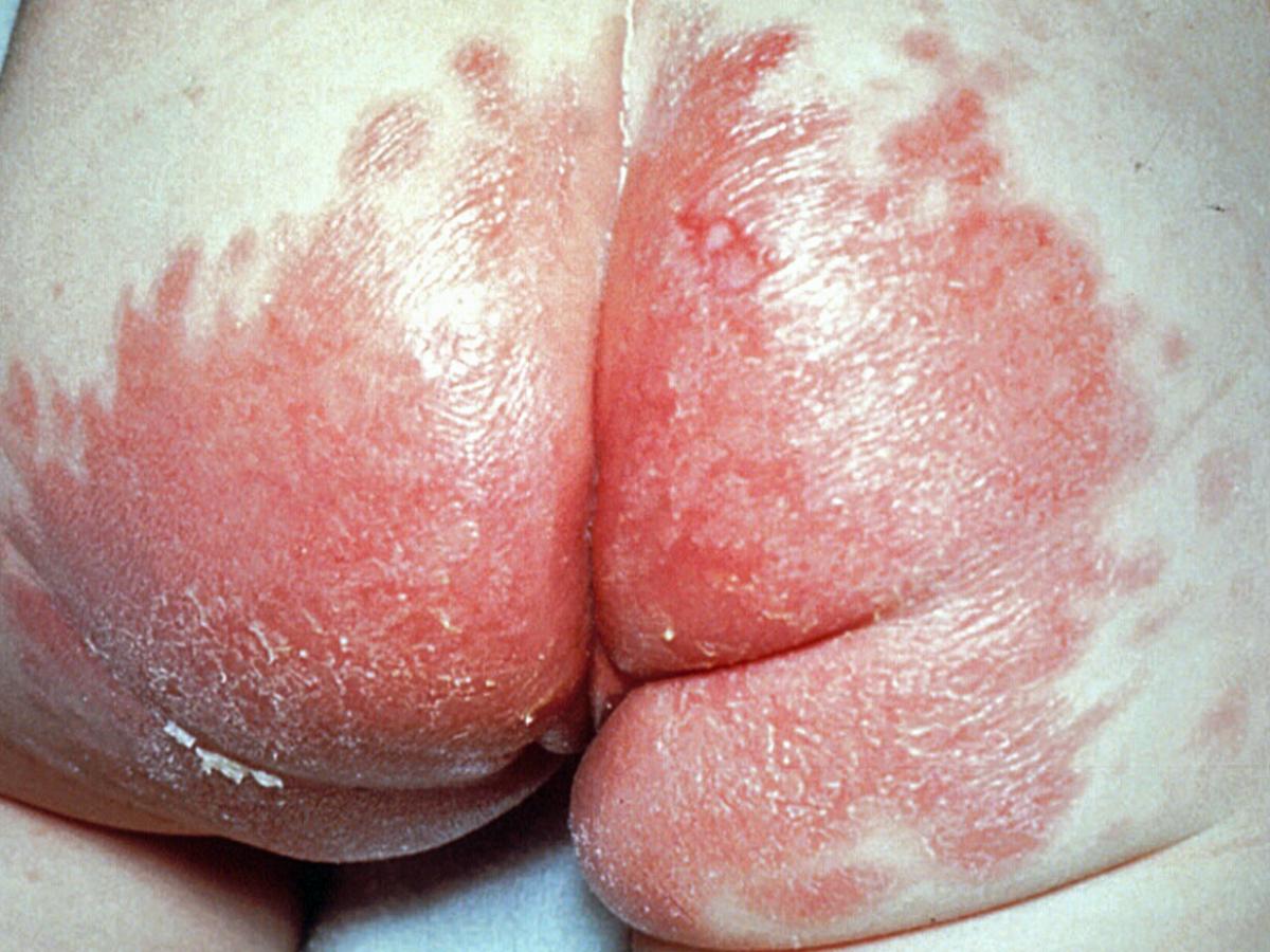Nappy rash candidiasis in an infant.