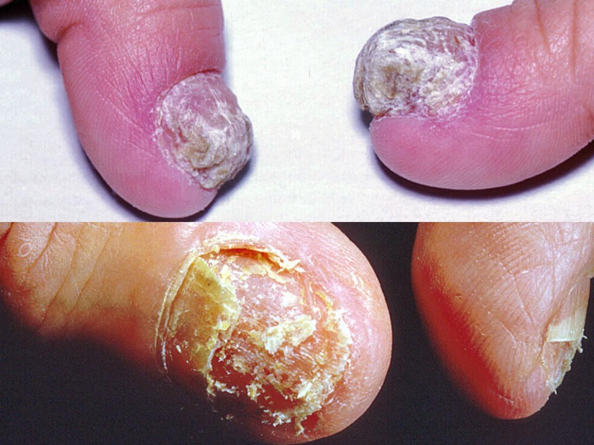 Candida onychomycosis showing complete destruction of nail tissue.