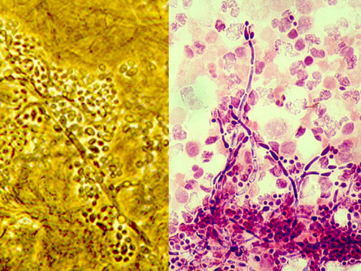 Budding yeast cells and pseudohyphae in a skin scraping and a PAS stained smear showing the presence of budding yeast cells and pseudohyphae in a urine specimen.