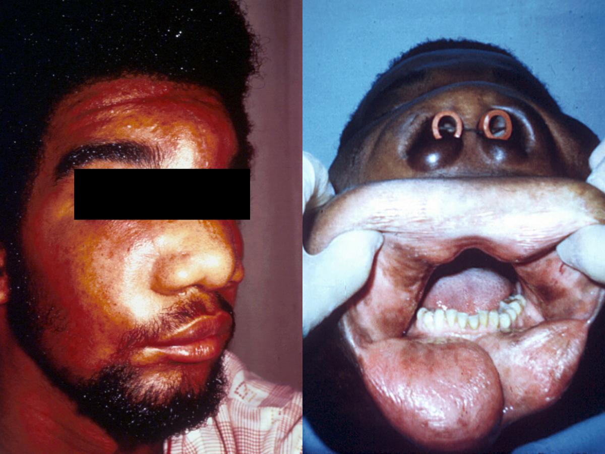 Zygomycosis caused by Conidiobolus (Courtesy of John Rippon, USA).