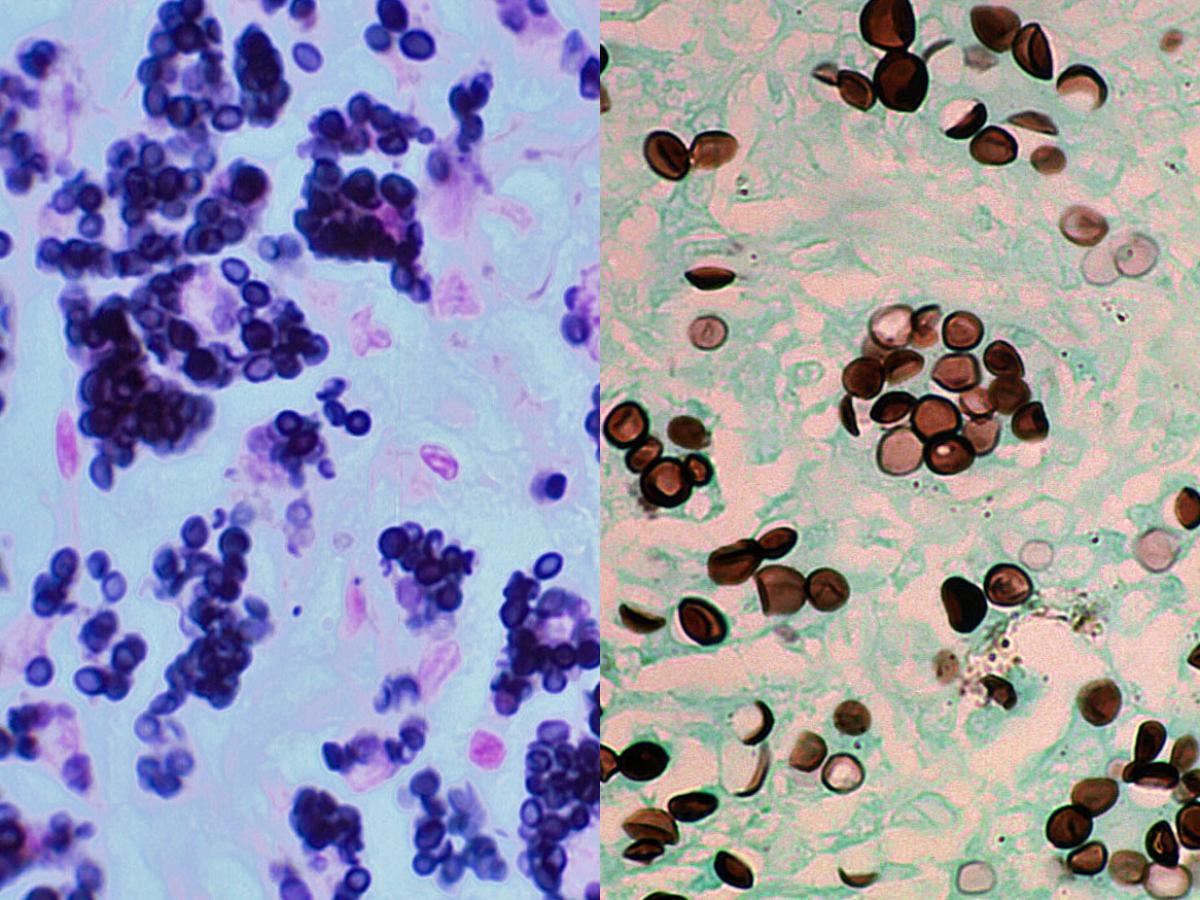 Histoplasmosis microscopy