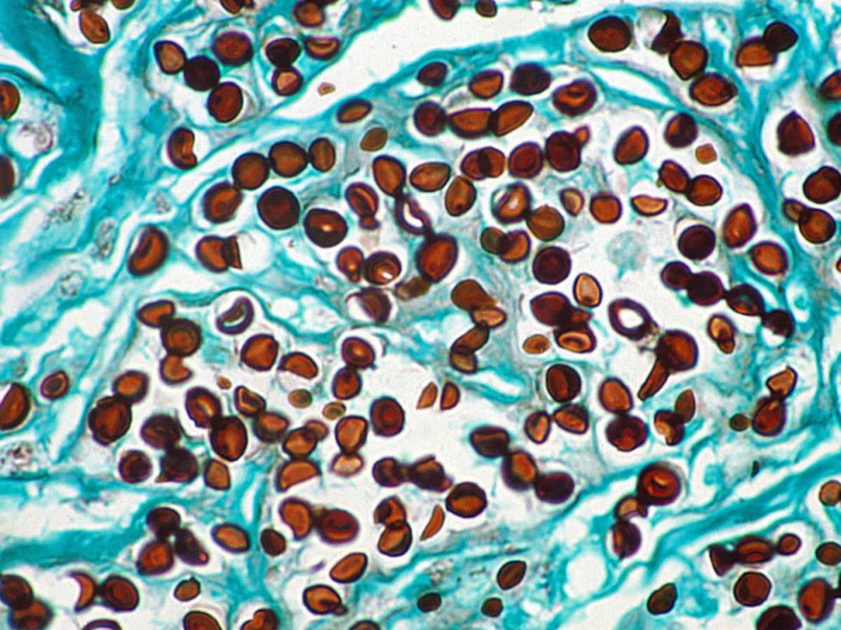 Lobomycosis histology