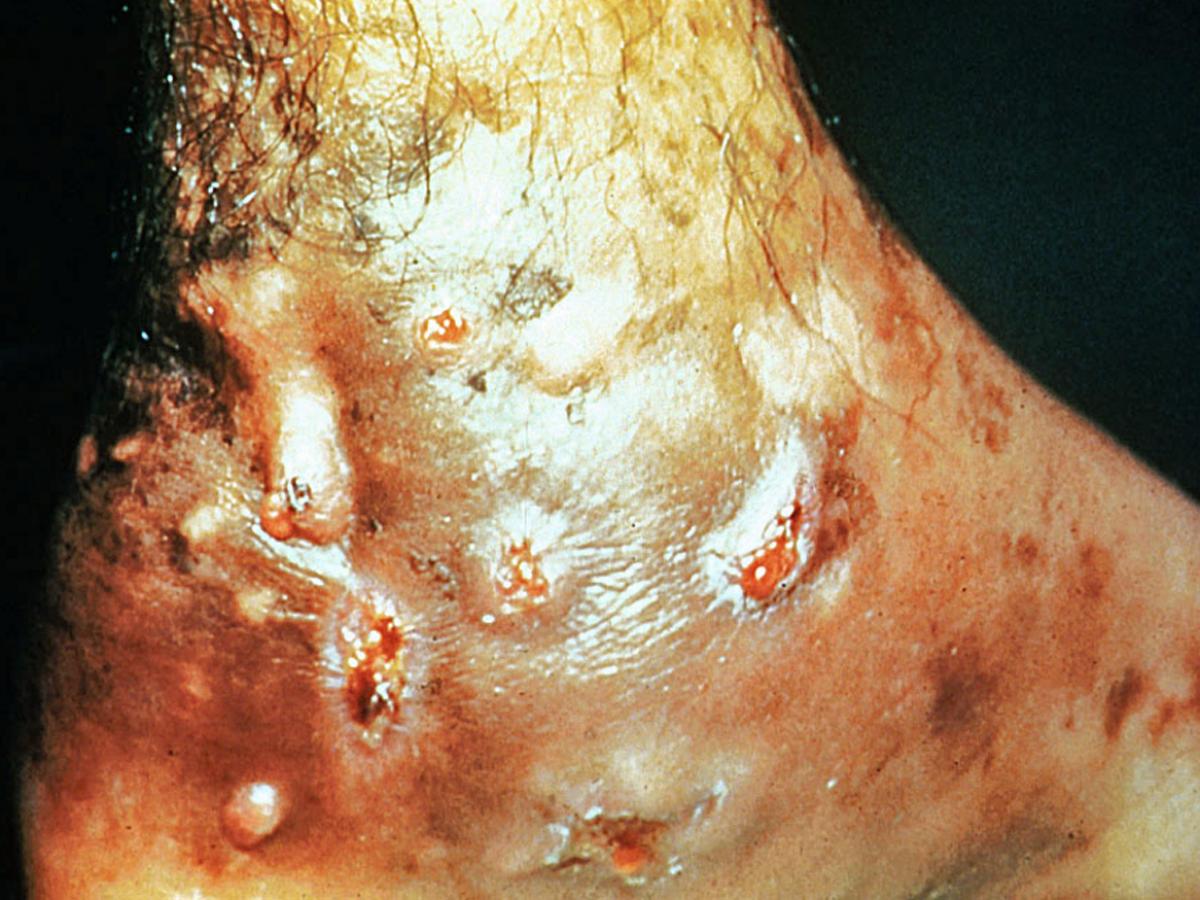 Mycetoma showing numerous draining sinuses