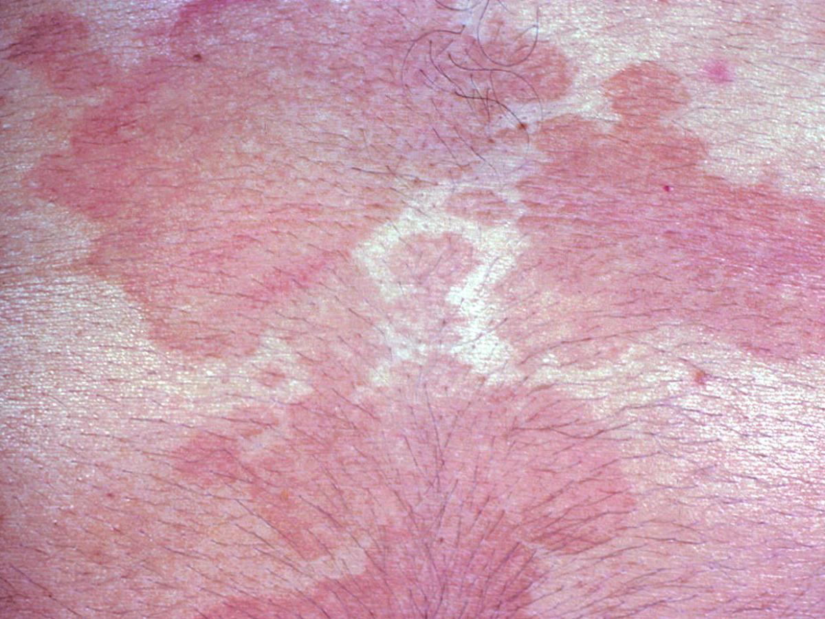 Pityriasis versicolor 2