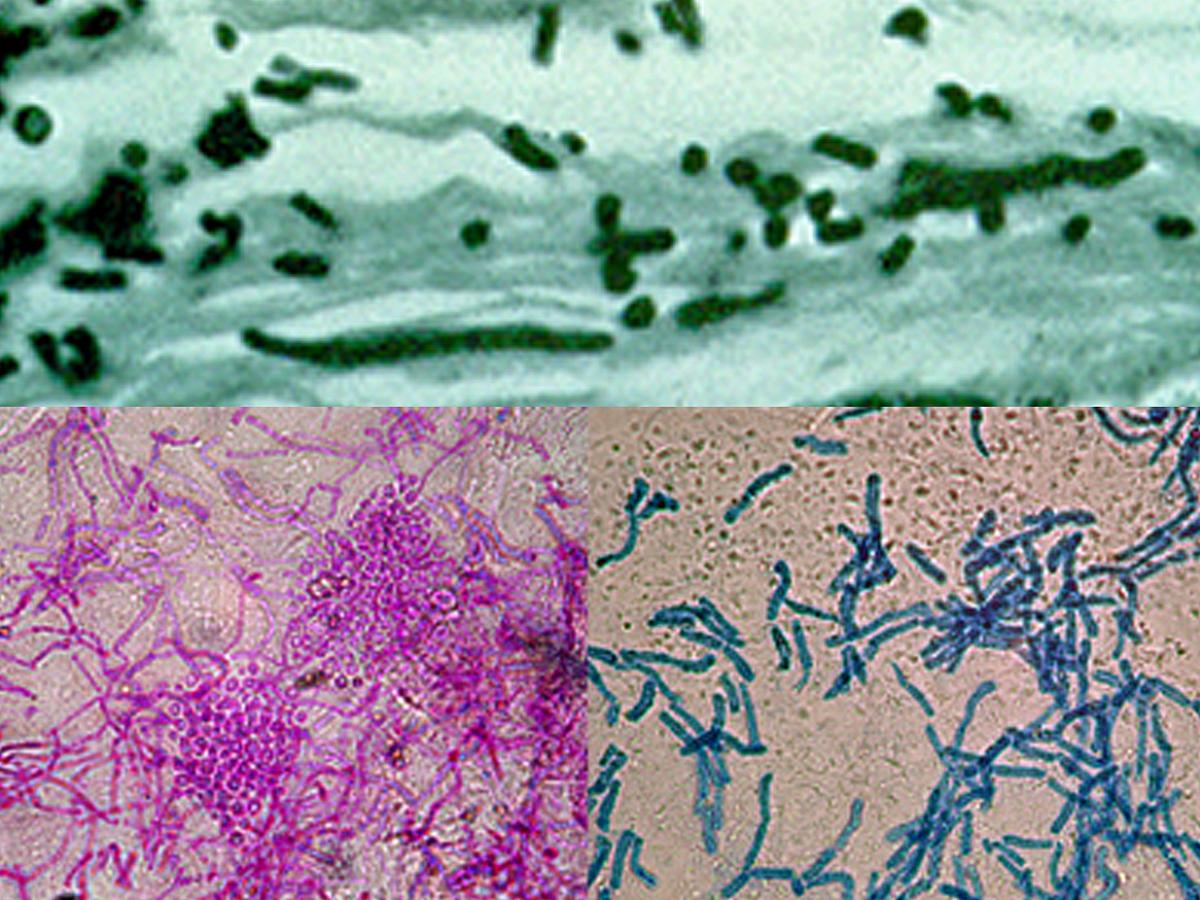 Pityriasis versicolor micro