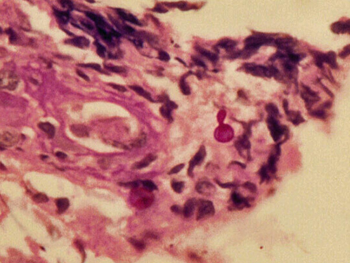 Histology of sporotrichosis.
