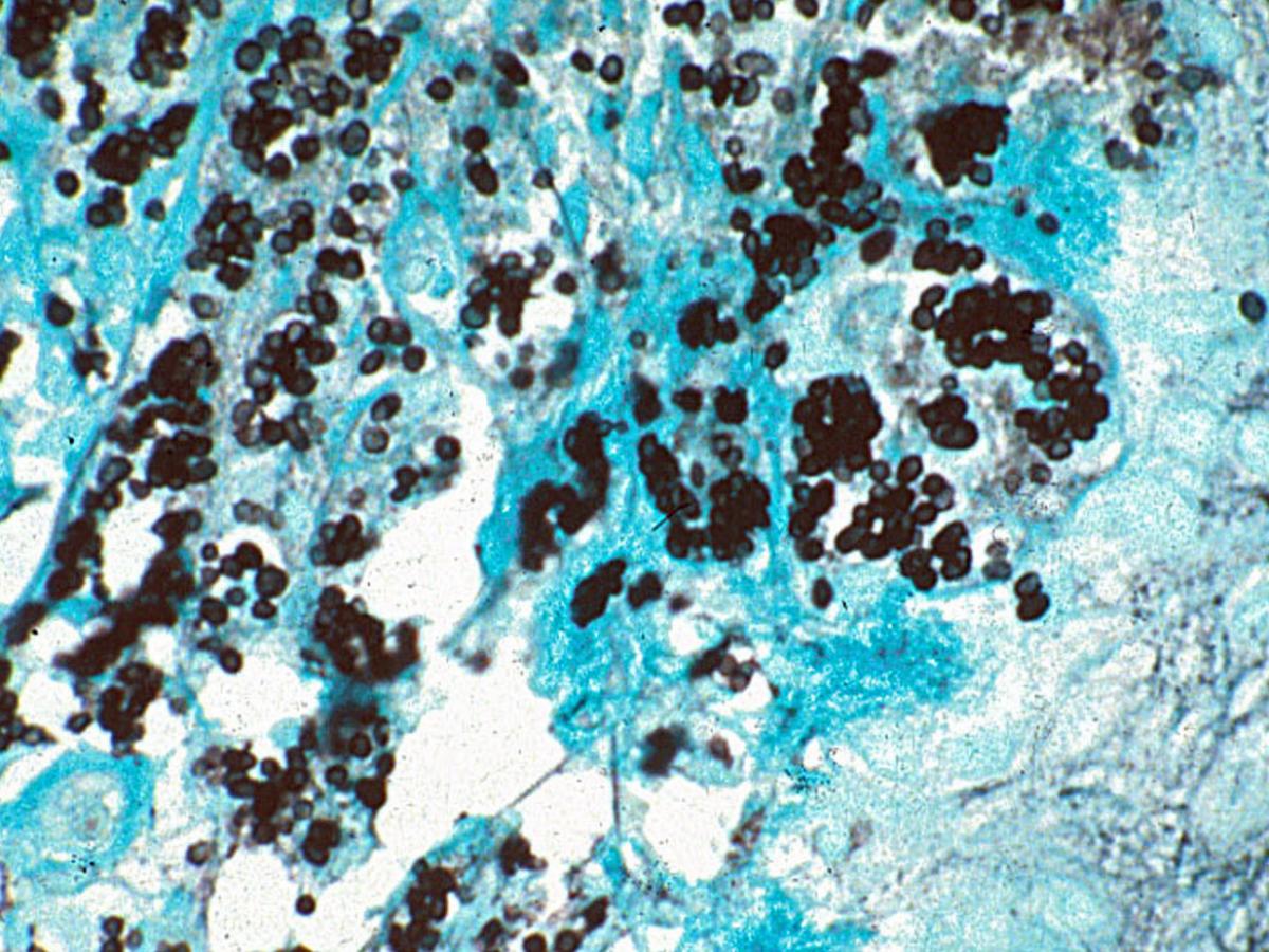 Unknown 10 Direct microscopy (GMS staining) - 1