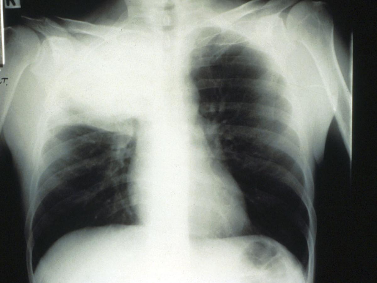 Unknown 44 chest X-ray