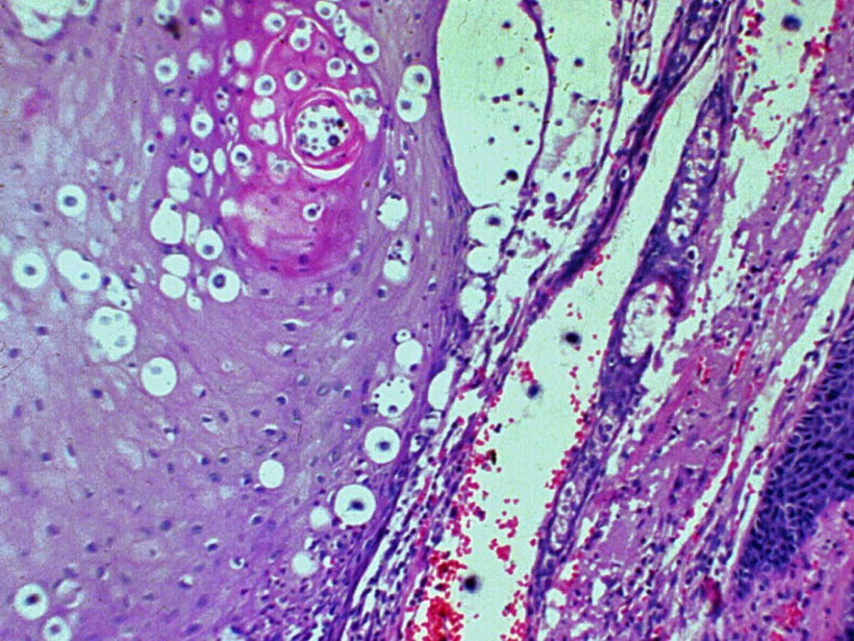 Unknown 44 histopathology