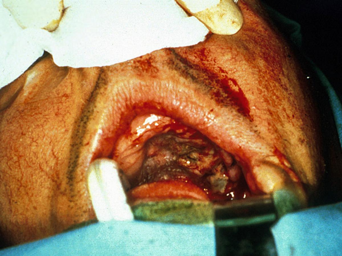 Rhinocerebral zygomycosis 